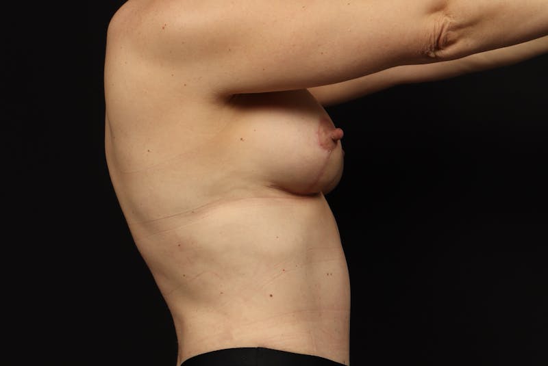 Mommy Makeover Before & After Gallery - Patient 299032 - Image 10