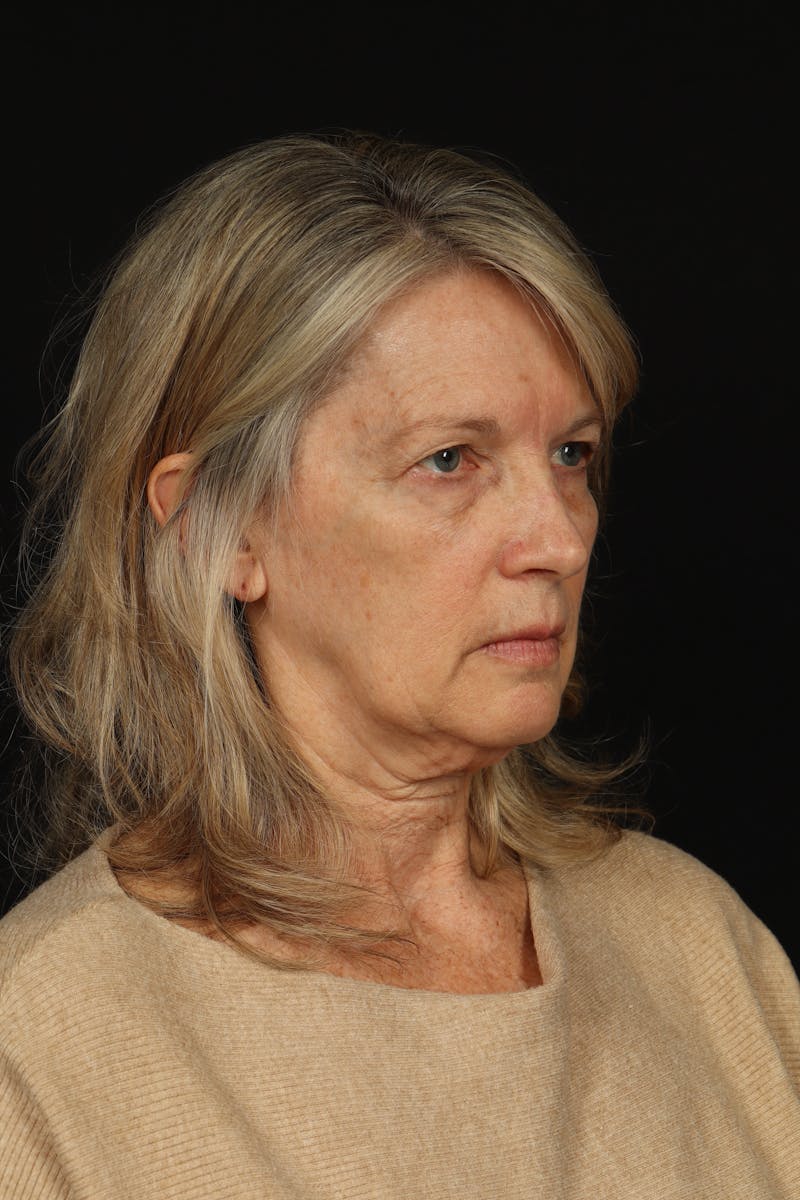 Facelift Before & After Gallery - Patient 130670 - Image 7