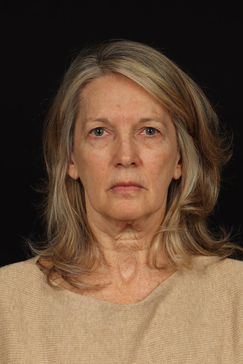 Facelift Before & After Gallery - Patient 130670 - Image 1