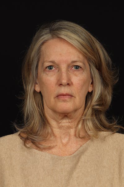 Facelift Before & After Gallery - Patient 130670 - Image 1