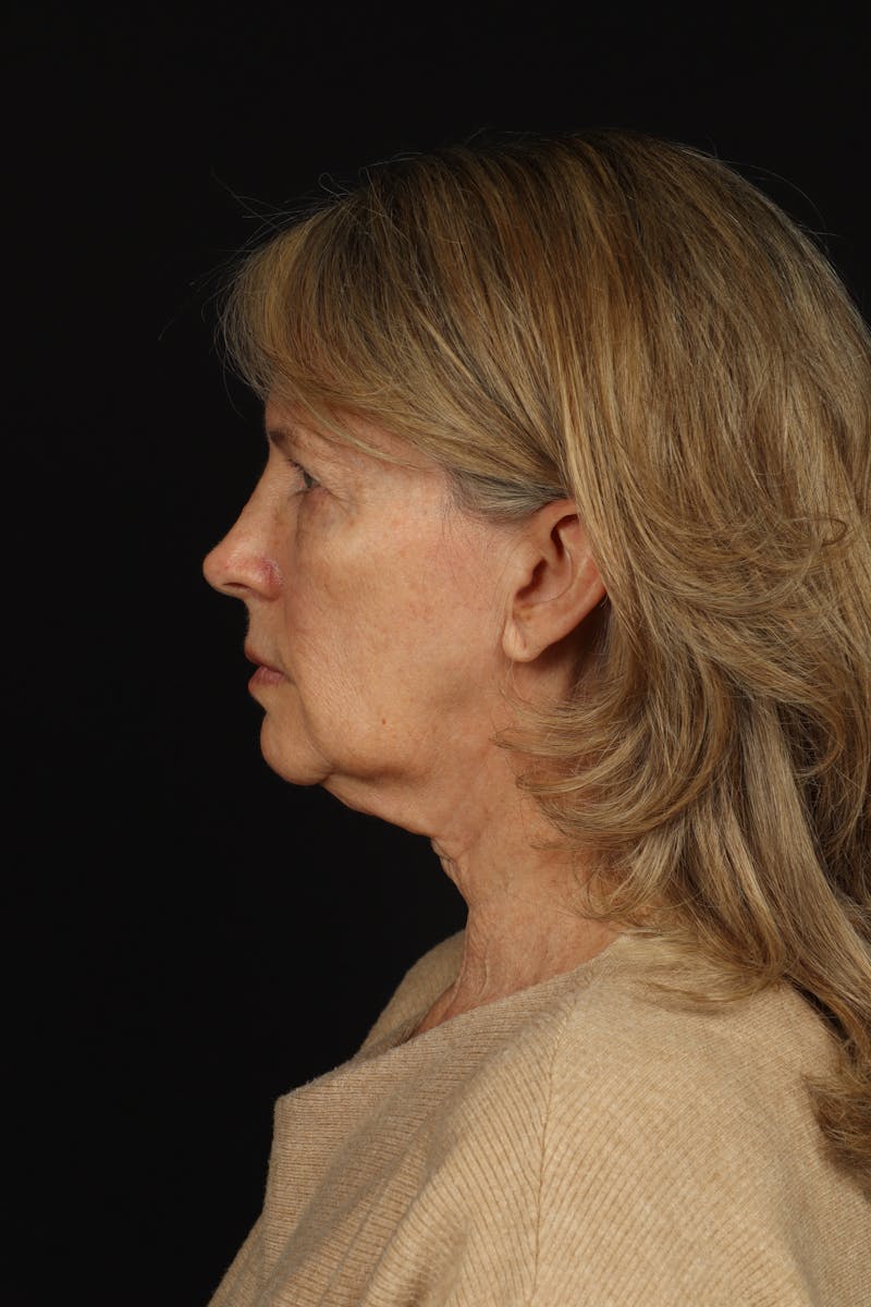 Facelift Before & After Gallery - Patient 130670 - Image 5