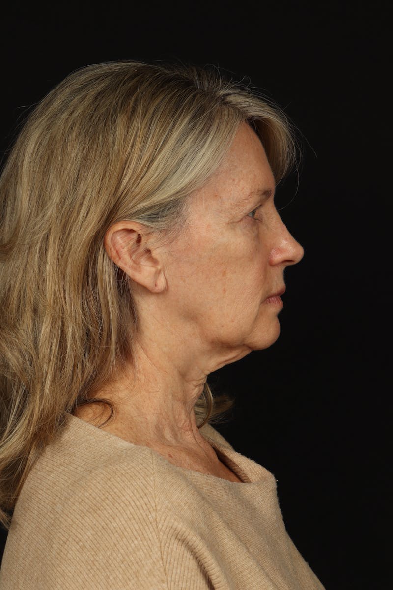 Facelift Before & After Gallery - Patient 130670 - Image 9