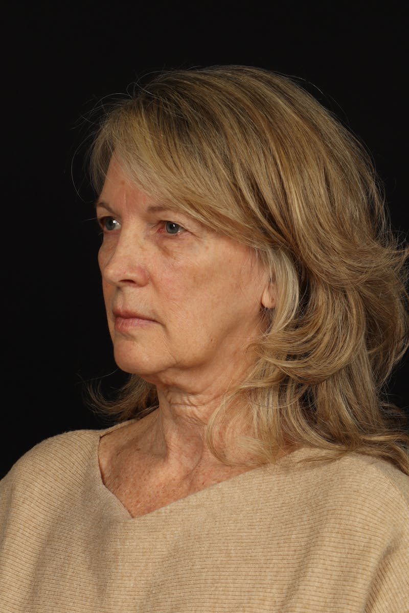 Facelift Before & After Gallery - Patient 130670 - Image 3
