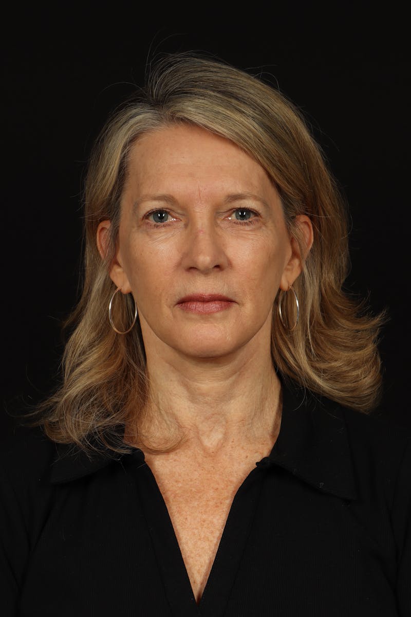 Facelift Before & After Gallery - Patient 130670 - Image 2