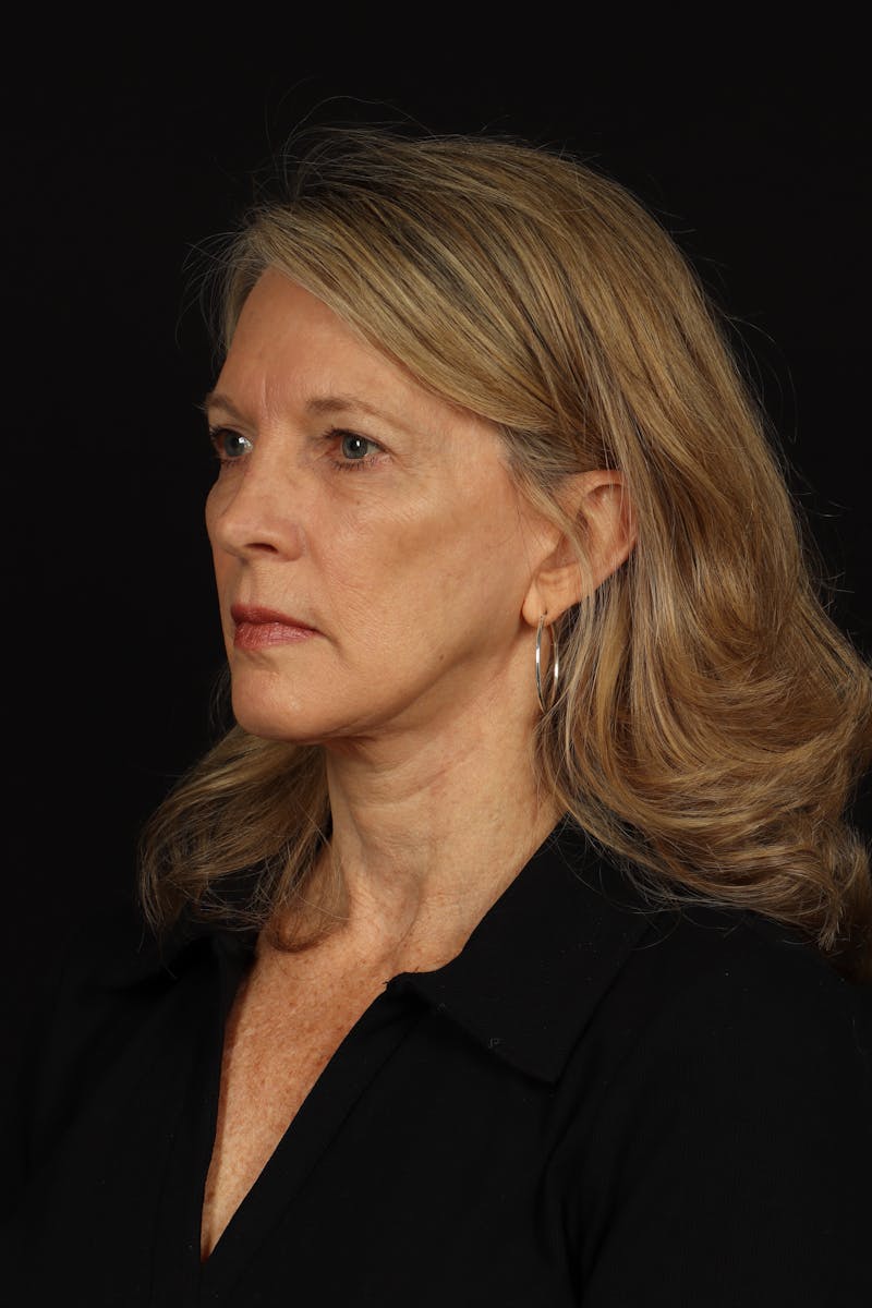 Facelift Before & After Gallery - Patient 130670 - Image 4