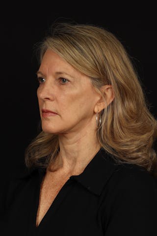 Facelift Before & After Gallery - Patient 130670 - Image 4