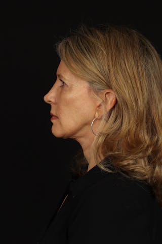 Facelift Before & After Gallery - Patient 130670 - Image 6