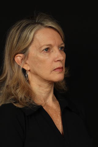 Facelift Before & After Gallery - Patient 130670 - Image 8