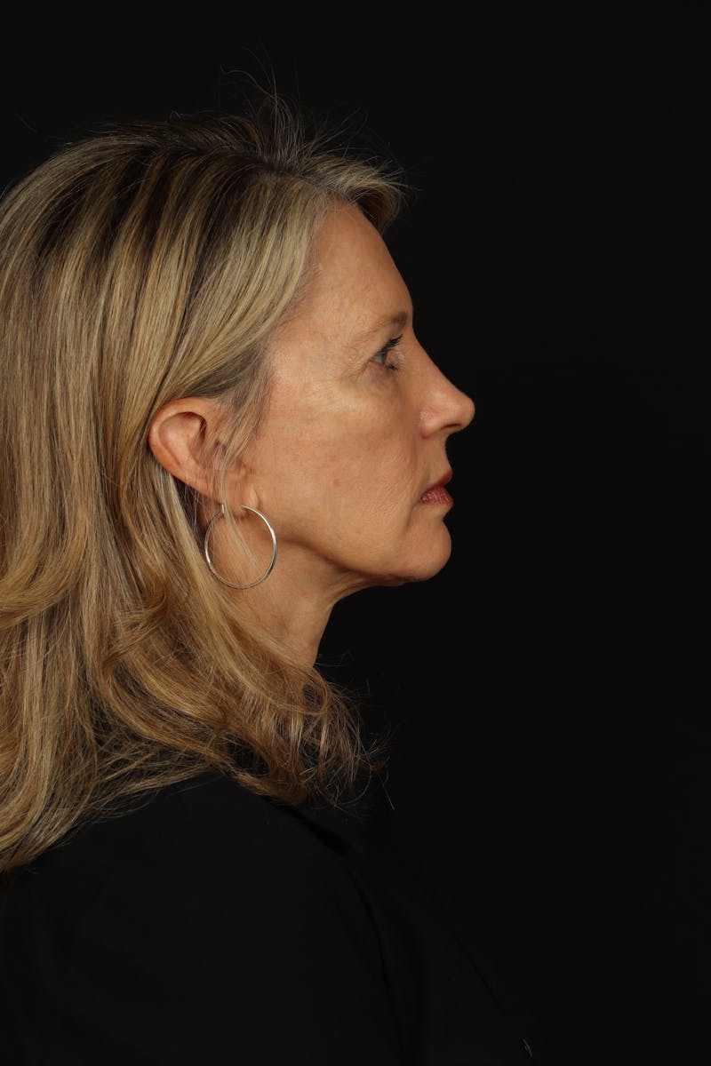 Facelift Before & After Gallery - Patient 130670 - Image 10