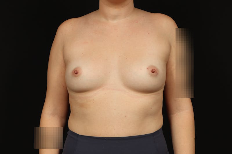Breast Augmentation Silicone Gel Before & After Gallery - Patient 147380 - Image 1