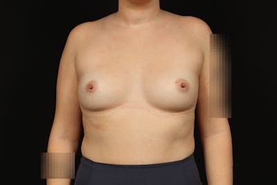 Breast Augmentation Silicone Gel Before & After Gallery - Patient 147380 - Image 1