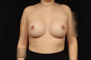 Breast Augmentation Silicone Gel Before & After Gallery - Patient 147380 - Image 2