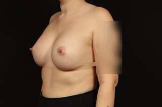 Breast Augmentation Silicone Gel Before & After Gallery - Patient 147380 - Image 4
