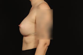 Breast Augmentation Silicone Gel Before & After Gallery - Patient 147380 - Image 6