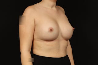 Breast Augmentation Silicone Gel Before & After Gallery - Patient 147380 - Image 8