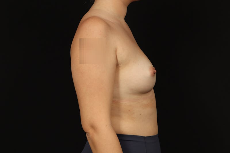 Breast Augmentation Silicone Gel Before & After Gallery - Patient 147380 - Image 9