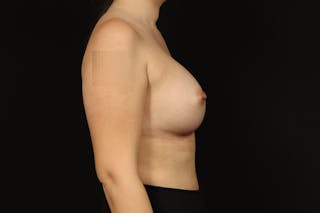 Breast Augmentation Silicone Gel Before & After Gallery - Patient 147380 - Image 10