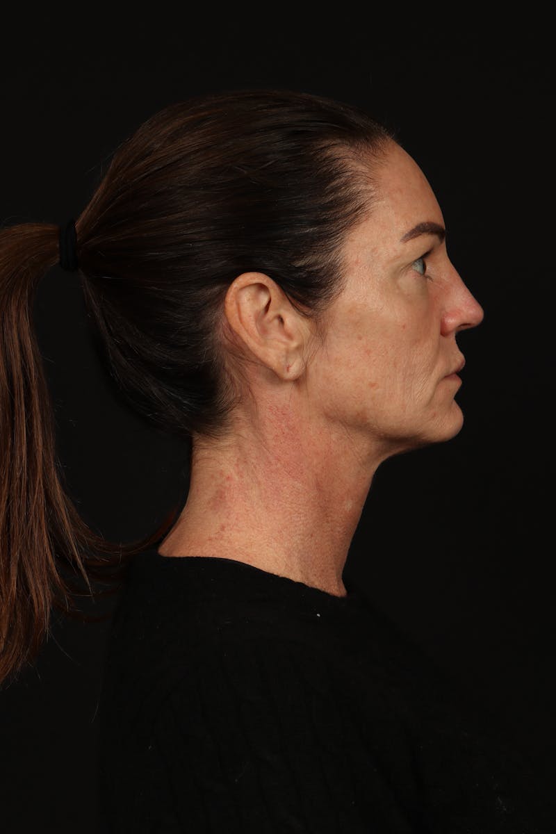 Facelift Before & After Gallery - Patient 267186 - Image 9