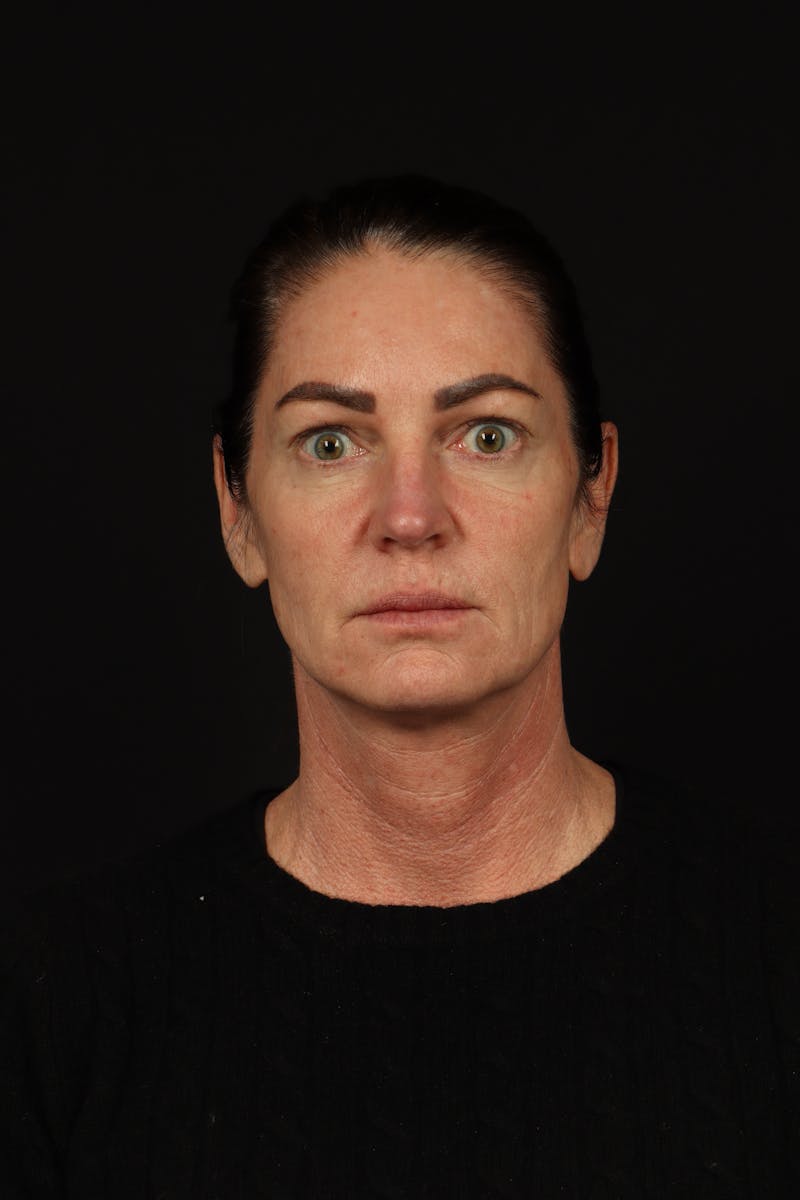 Facelift Before & After Gallery - Patient 267186 - Image 1
