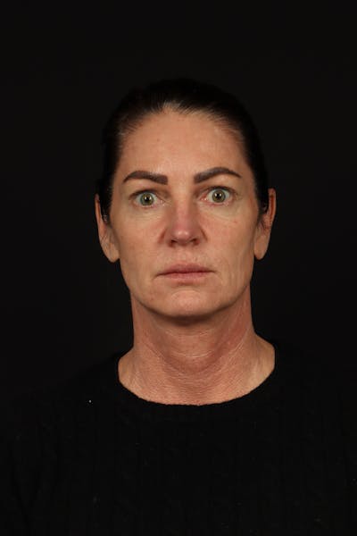 Facelift Before & After Gallery - Patient 267186 - Image 1