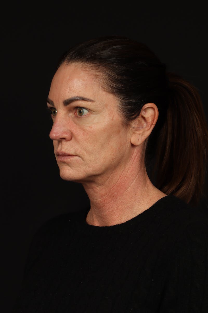 Facelift Before & After Gallery - Patient 267186 - Image 3
