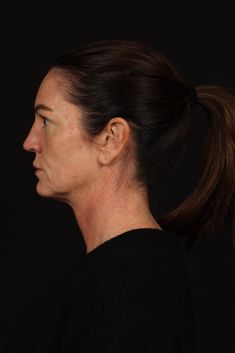 Facelift Before & After Gallery - Patient 267186 - Image 5