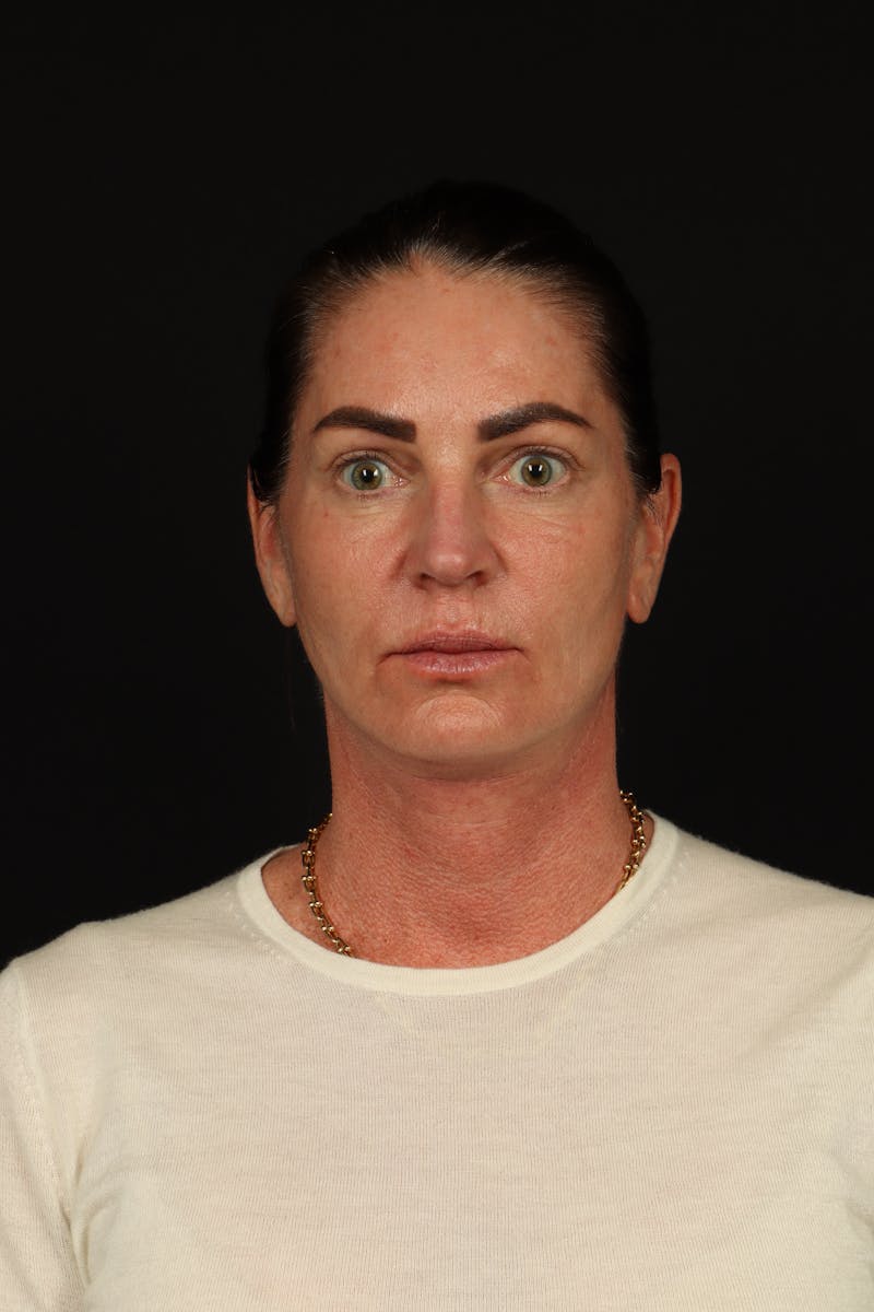 Facelift Before & After Gallery - Patient 267186 - Image 2