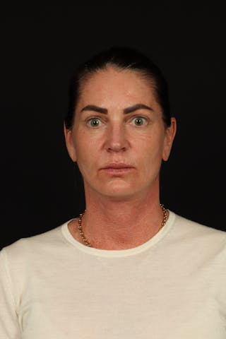 Facelift Before & After Gallery - Patient 267186 - Image 2