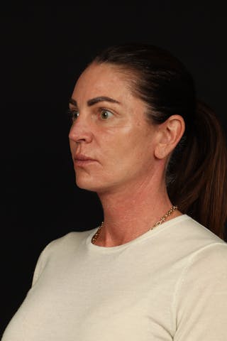 Facelift Before & After Gallery - Patient 267186 - Image 4