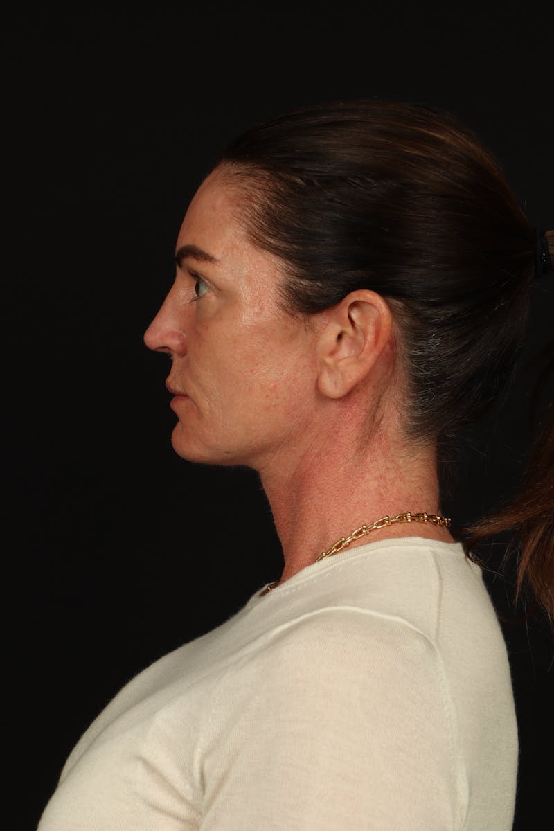 Facelift Before & After Gallery - Patient 267186 - Image 6