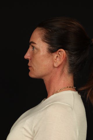 Facelift Before & After Gallery - Patient 267186 - Image 6