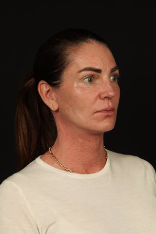 Facelift Before & After Gallery - Patient 267186 - Image 8