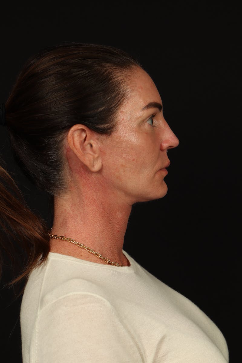 Facelift Before & After Gallery - Patient 267186 - Image 10