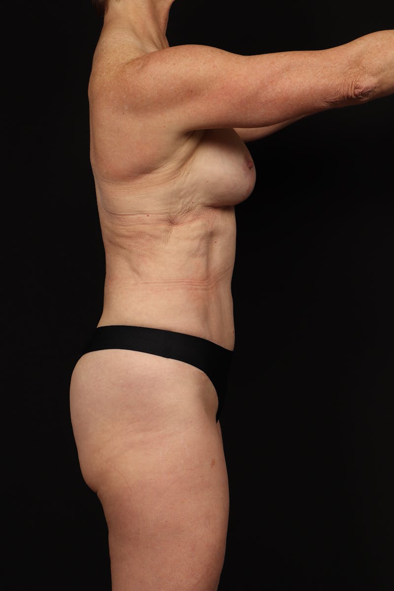 Aesthetic Breast Revision Before & After Gallery - Patient 177424 - Image 10