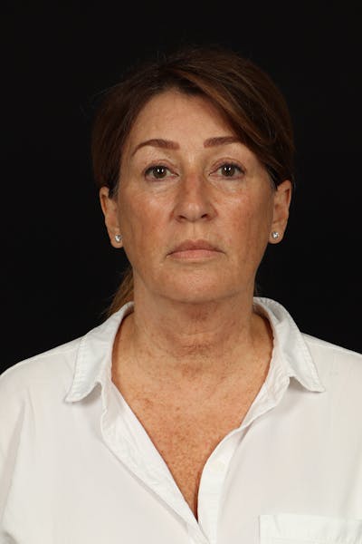 Facelift Before & After Gallery - Patient 165029 - Image 1