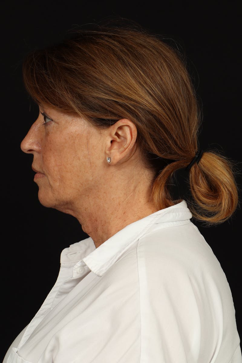 Facelift Before & After Gallery - Patient 165029 - Image 5