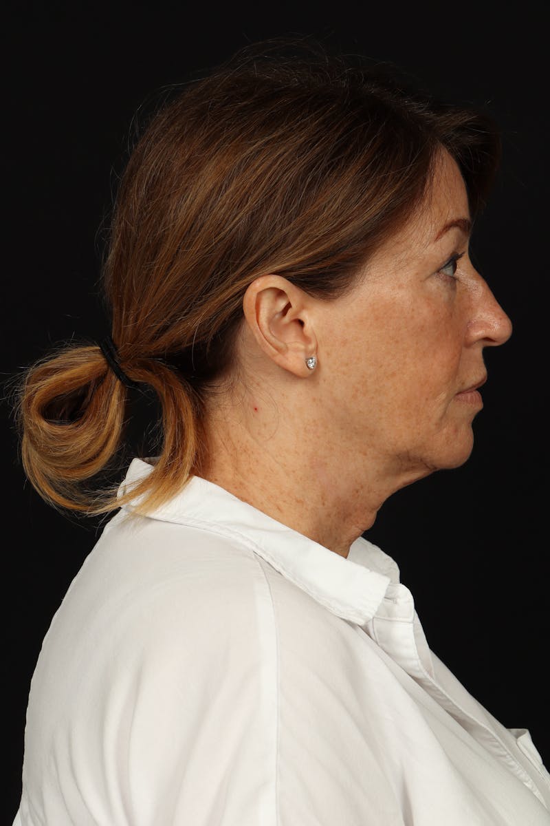 Facelift Before & After Gallery - Patient 165029 - Image 9