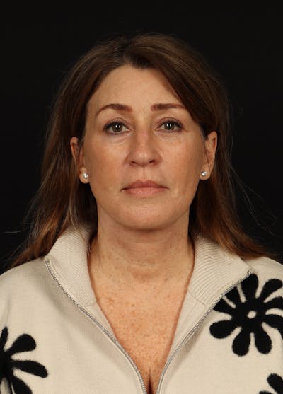 Facelift Before & After Gallery - Patient 165029 - Image 2