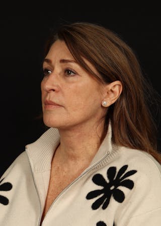 Facelift Before & After Gallery - Patient 165029 - Image 4