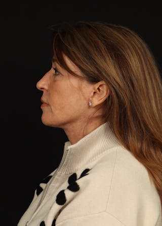 Facelift Before & After Gallery - Patient 165029 - Image 6