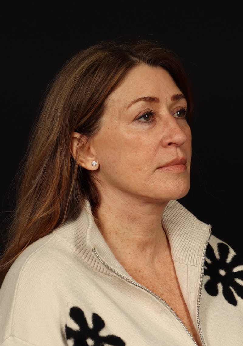 Facelift Before & After Gallery - Patient 165029 - Image 8