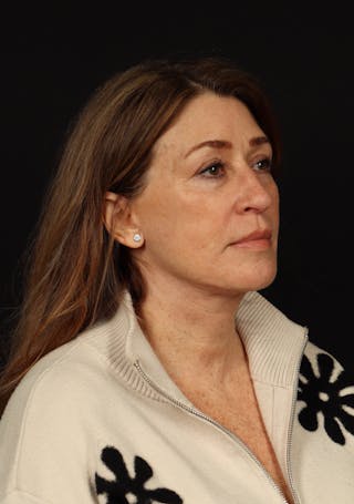 Facelift Before & After Gallery - Patient 165029 - Image 8