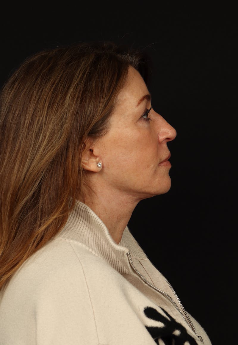 Facelift Before & After Gallery - Patient 165029 - Image 10