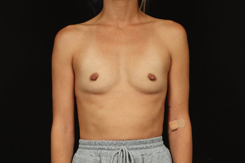 Breast Augmentation Silicone Gel Before & After Gallery - Patient 374117 - Image 1