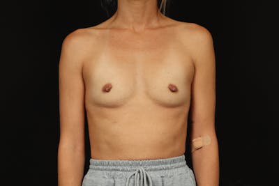 Breast Augmentation Silicone Gel Before & After Gallery - Patient 374117 - Image 1