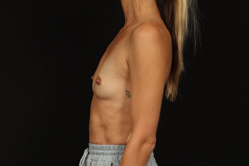 Breast Augmentation Silicone Gel Before & After Gallery - Patient 374117 - Image 5