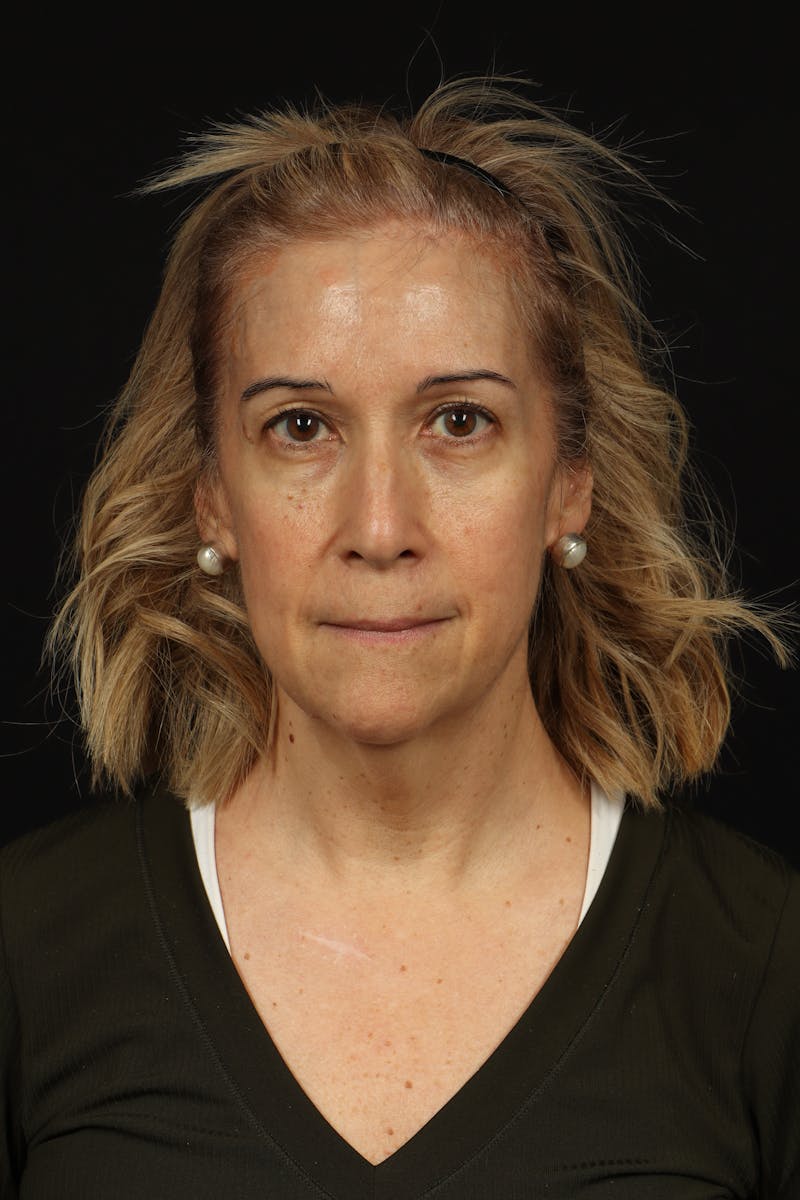 Facelift Before & After Gallery - Patient 439276 - Image 1