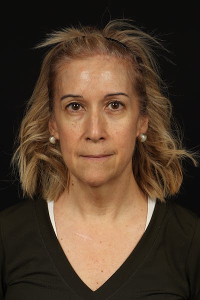 Facelift Before & After Gallery - Patient 439276 - Image 1