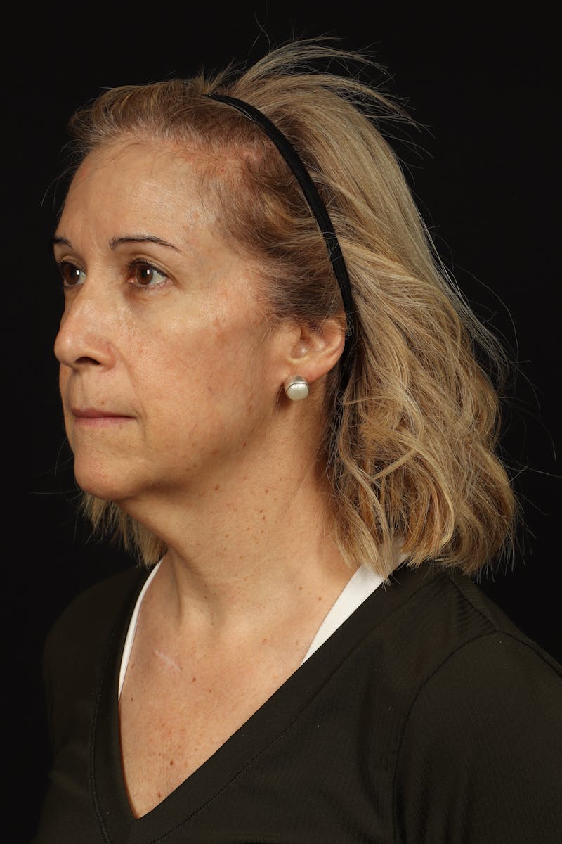 Facelift Before & After Gallery - Patient 439276 - Image 3