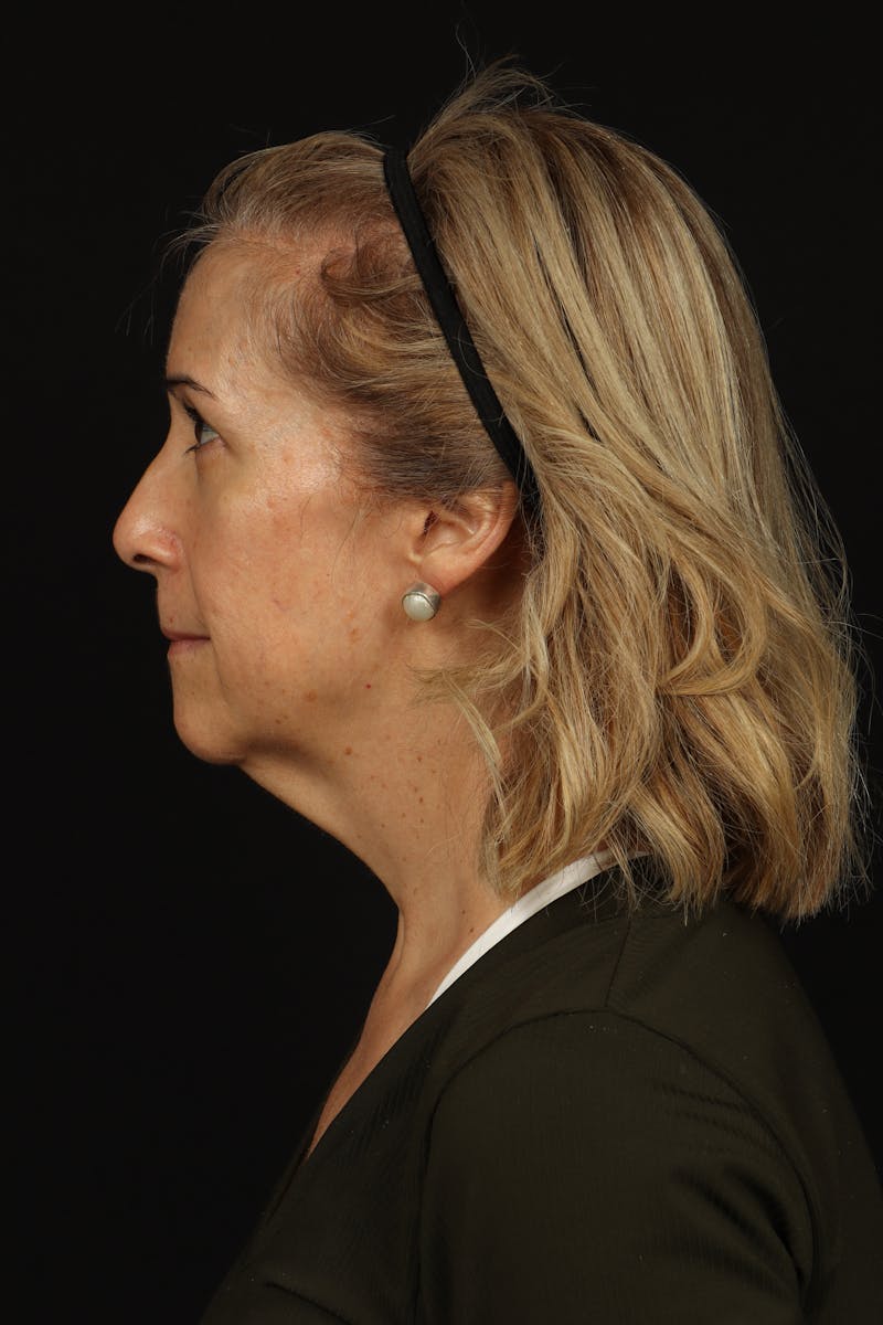 Facelift Before & After Gallery - Patient 439276 - Image 5